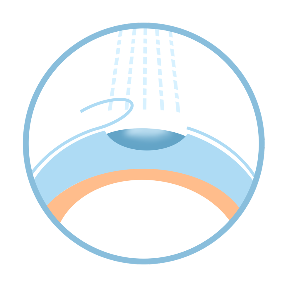 lasik_smile_compare